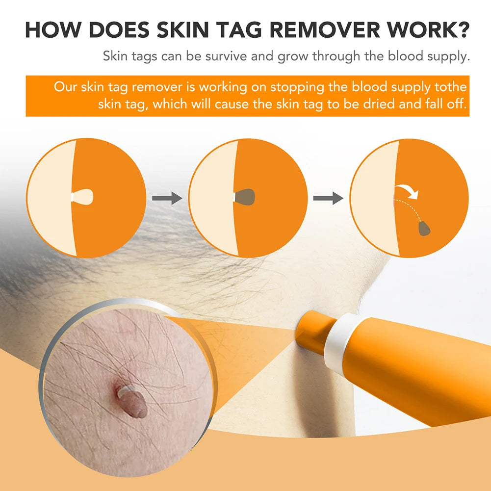 Rubber Rings Skin Tag Removal Tool Face Beauty Accessories Skin Tag Removal Device Multipurpose Supplies for Face Neck Chin Back