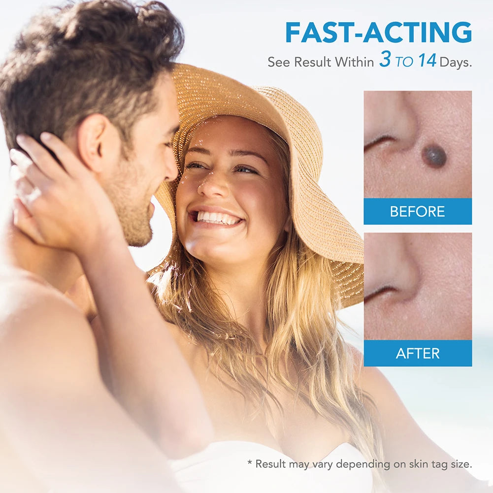 Rubber Rings Skin Tag Removal Tool Face Beauty Accessories Skin Tag Removal Device Multipurpose Supplies for Face Neck Chin Back