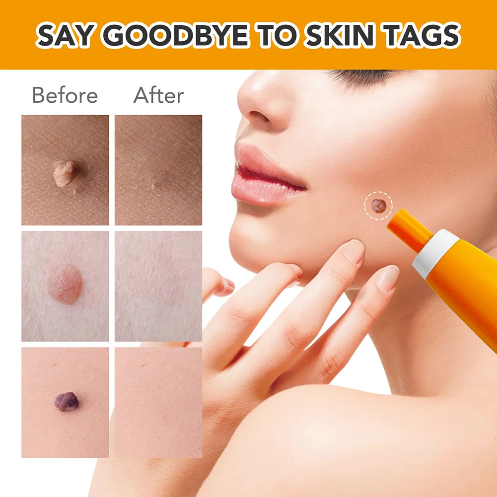 Rubber Rings Skin Tag Removal Tool Face Beauty Accessories Skin Tag Removal Device Multipurpose Supplies for Face Neck Chin Back